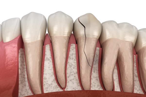 How Your Dentist Can Fix A Broken Tooth