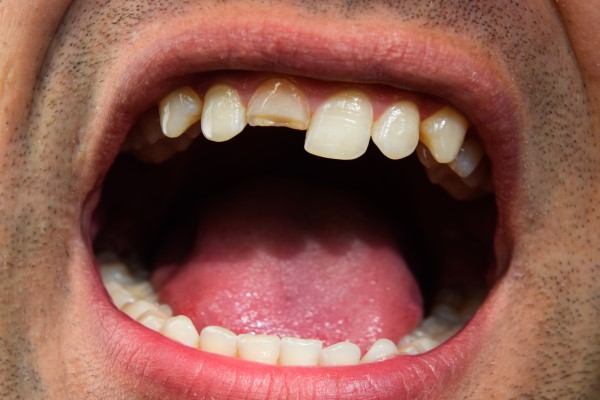 Emergency Dental Care: How To Handle A Broken Tooth After Hours